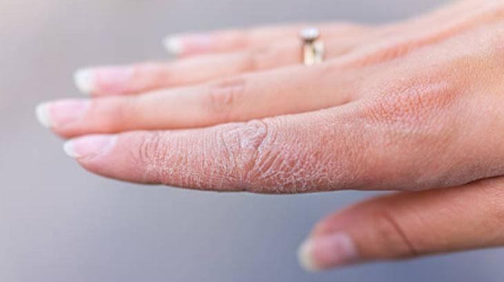 Soğuktan çatlarsa çaresi zeytinyağı-şekerde Pamuğa dönecek, doğal peeling