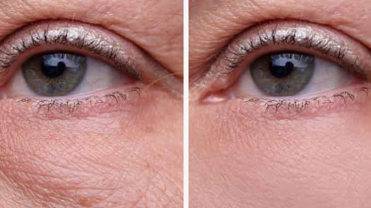 50 liraya doğal kapatıcı 2 malzeme yetiyor, şişliğe de morluğa da çare