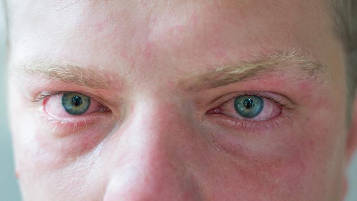 Ağlamaktan şişen gözler anında sönecek İyi hissettiren kafein devrede