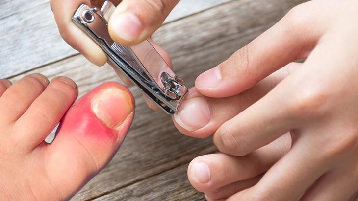 Tırnak batığı sıklıkla ayak başparmağında görülüyor