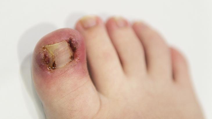 Tırnak batığının oluşumundaki en yaygın nedenler…