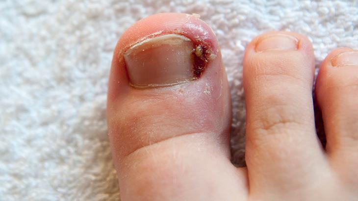 Tırnak batığının teşhisi nasıl konur