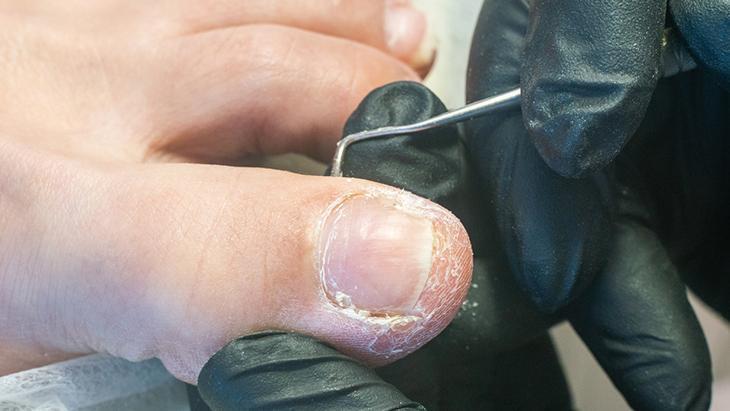 Tırnak batığında tırnak kesim teknikleri önemli