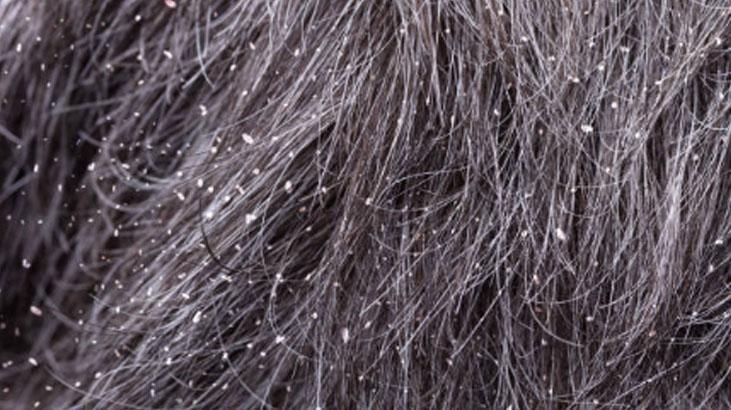 Saçta da bahar temizliği şart Yüzde 90 işe yarıyor, kepek eriyip gidiyor Saçta da bahar temizliği şart Yüzde 90 işe yarıyor, kepek eriyip gidiyor