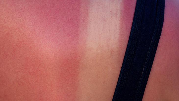 Güneş yanığına yulaf mucizesi Kremsiz ferahlık, anında serinletiyor