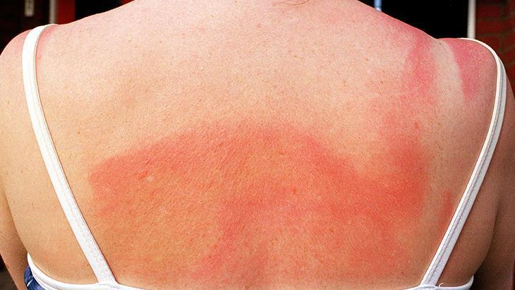 Güneş yanığına yulaf mucizesi Kremsiz ferahlık, anında serinletiyor