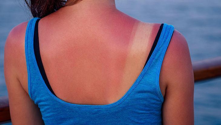 Güneş yanığına yulaf mucizesi Kremsiz ferahlık, anında serinletiyor