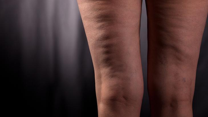 Kol ve bacaklarınızdaki morarmaları önemseyin