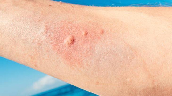 ARI SOKMASINA KARŞI DİĞER YÖNTEM