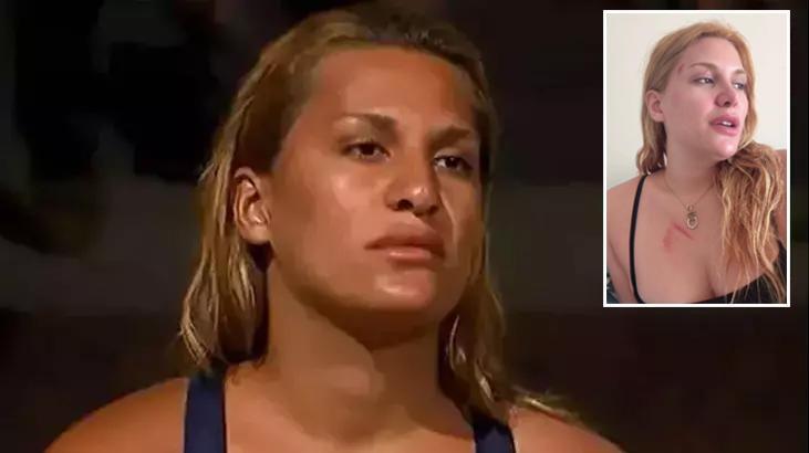 Survivor Almeda Baylan kaza geçirdi! O anları ve son durumunu anlattı: Ölümden döndük – Magazin Haberleri