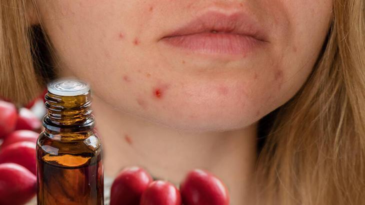 Yara izlerini bile kapatan ev yapımı serum Cildi anında onarıyor, ne akne kalacak ne sivilce Yara izlerini bile kapatan ev yapımı serum Cildi anında onarıyor, ne akne kalacak ne sivilce