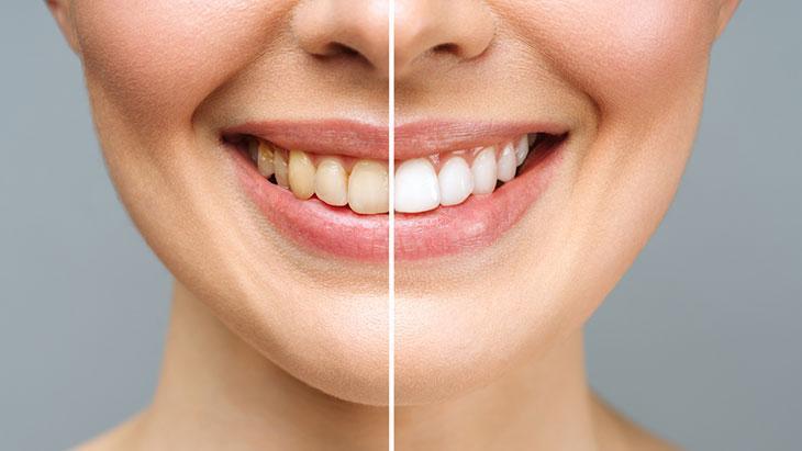 D ve C vitaminleri ile beyazlık süresi desteklenmeli