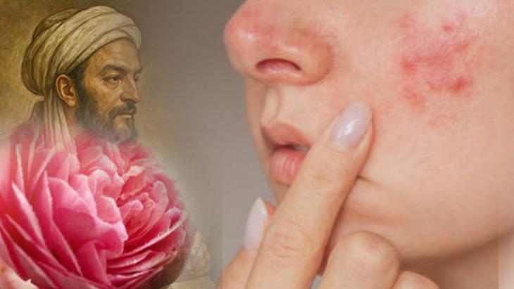 Ciltteki her lekenin çaresiymiş İbn-i Sina’nın sırrı: Dereotu ve sirke yeter Ciltteki her lekenin çaresiymiş İbn-i Sina’nın sırrı: Dereotu ve sirke yeter