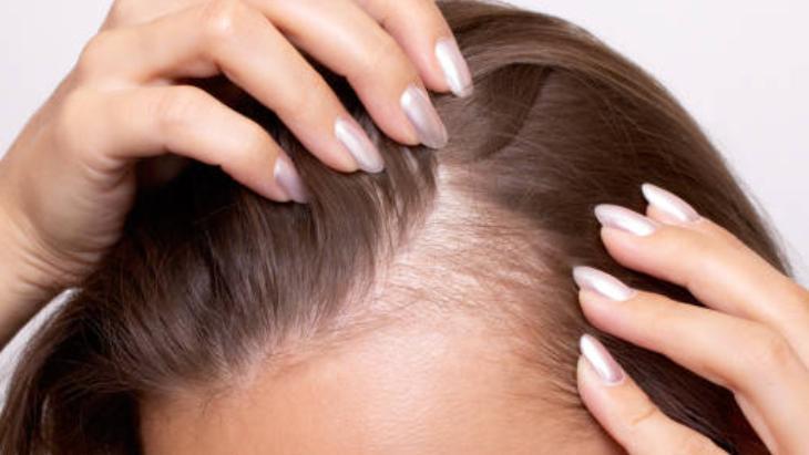 SAÇ DÖKÜLMESİ VE KELLEŞME DERDİNE SON SAÇ DÖKÜLMESİ VE KELLEŞME DERDİNE SON