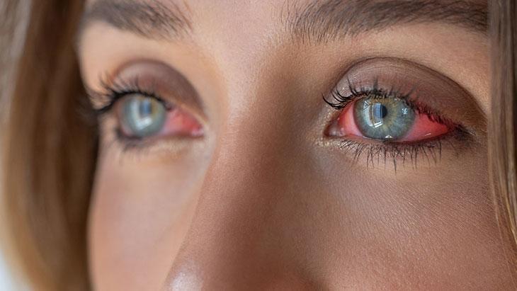 Göz alerjisi görme kaybına neden oluyor! Kontakt lens kullanımı riski artırıyor