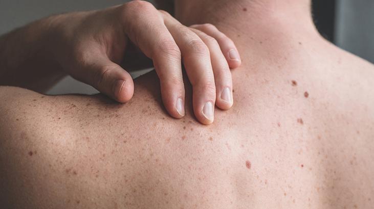 2- Zerdeçal ve yoğurt maskesi