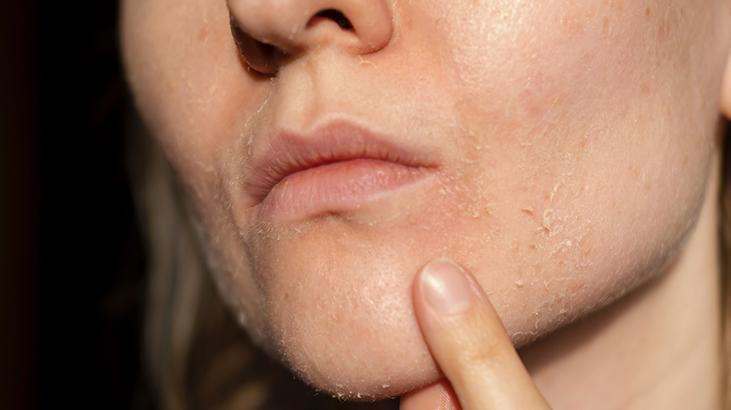 Cilt lekelerini uçuran limon kürü 20 dakika uygulayan farkı görüyor, herkeste var