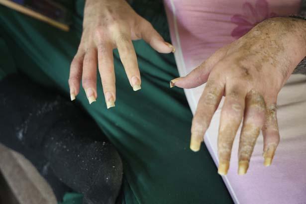 Vali emriyle gelen değişim 23 yaşında, 3 yıldır evde... Duş almıyor, tırnaklarını kesmiyordu