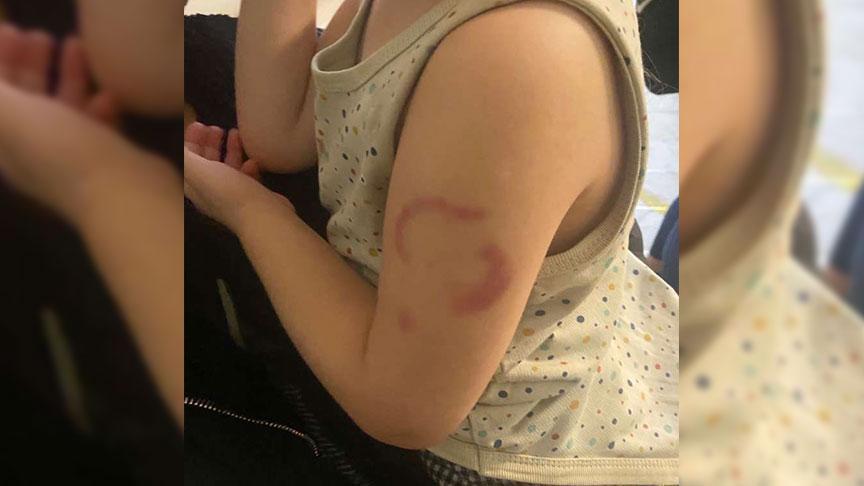 Edirne'de akılalmaz olay! Öğretmen, 3 yaşındaki çocuğu ısırdı: Öperken oldu