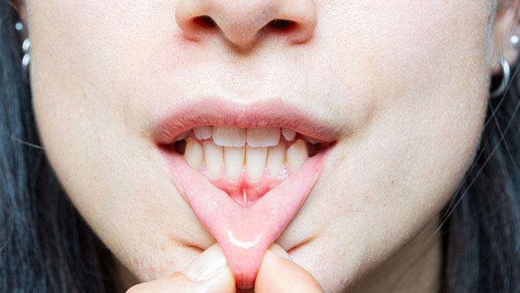 El tratamiento se planifica una vez que las encías recuperen su salud.