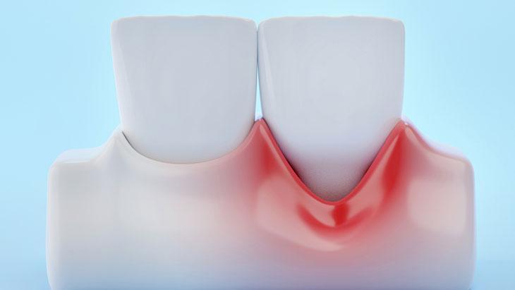 Una vez retirados los puntos, el paciente puede retomar su rutina normal.