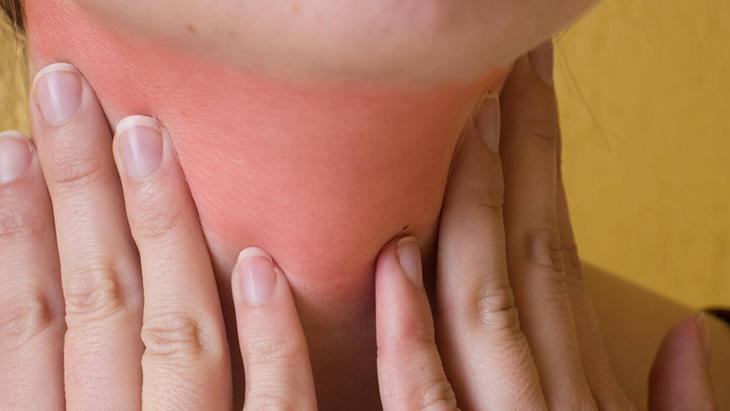 4- Çok sıcak yiyecek ve içecekler