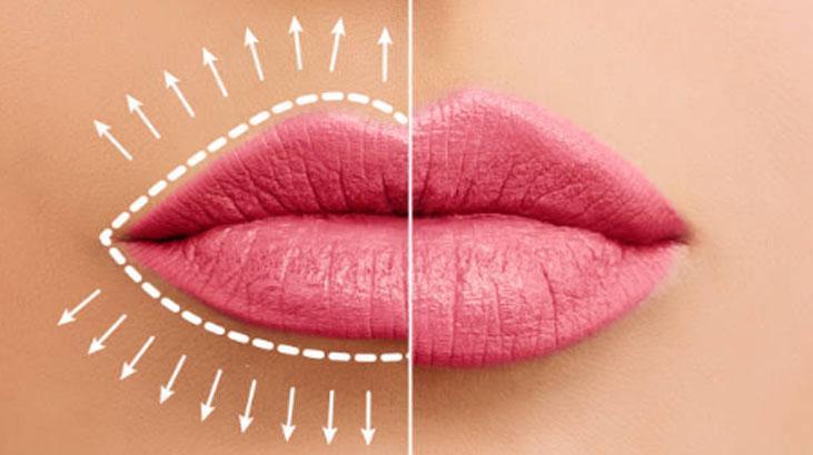 Dolguya gerek kalmadan şişiyor Dolgun dudakların sırrı bu malzemedeymiş