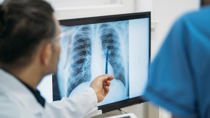 Akciğer kanseri neden sigara içmeyenlerde görülüyor Akciğer kanseri neden sigara içmeyenlerde görülüyor