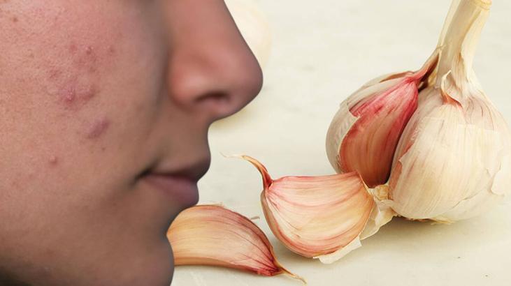 Sarımsak gargarası hepsinden güçlü Mikropları def eden doğal ilaç