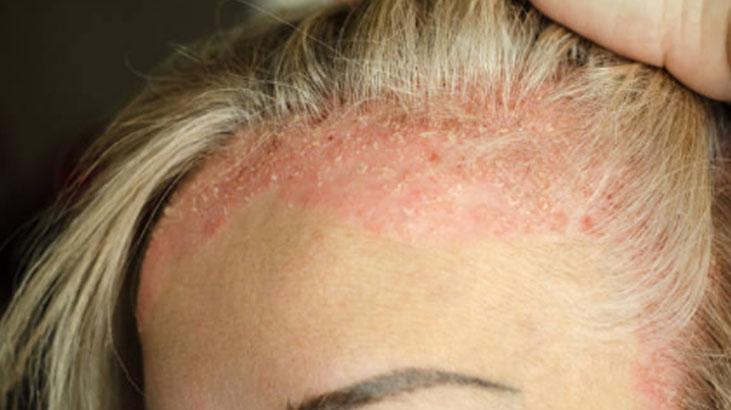 Egzama ve kuruluğa doğal retinol Cildi canlandıran ürünün tek damlası yetiyor