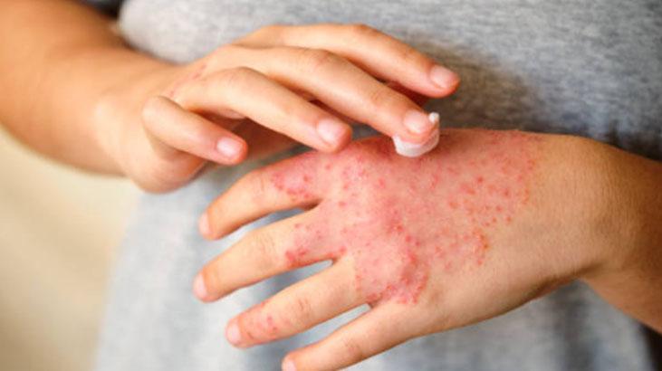 Egzama ve kuruluğa doğal retinol Cildi canlandıran ürünün tek damlası yetiyor