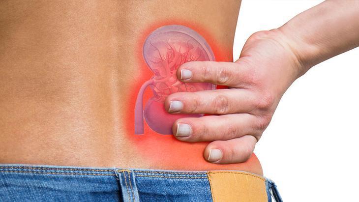 Uzmanından böbrek taşının belirtisi herkeste farklıdır uyarısı