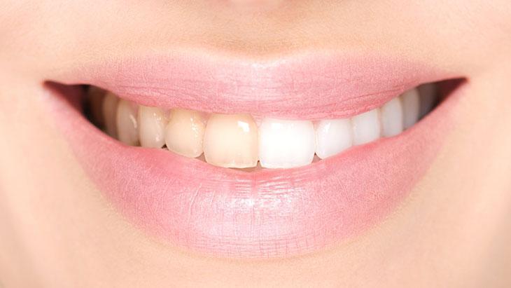 Karbonat tek başına florür içermemesi nedeniyle çürük koruması sağlamıyor