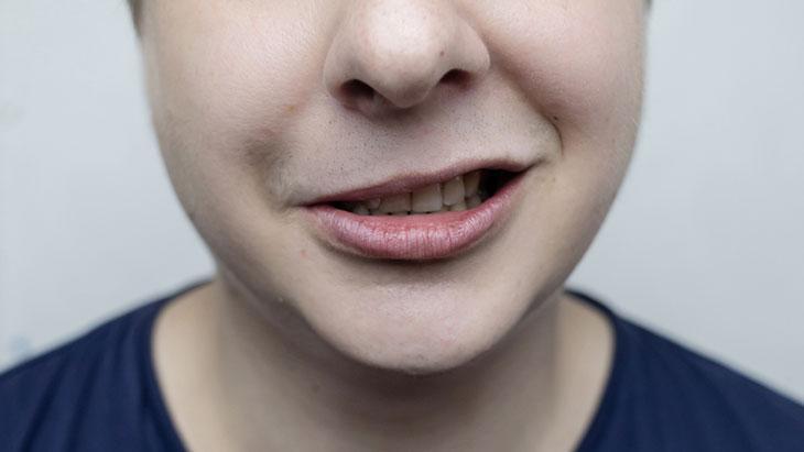 Yüz sinirindeki iletim bozukluğuyla gelişiyor Yüz sinirindeki iletim bozukluğuyla gelişiyor