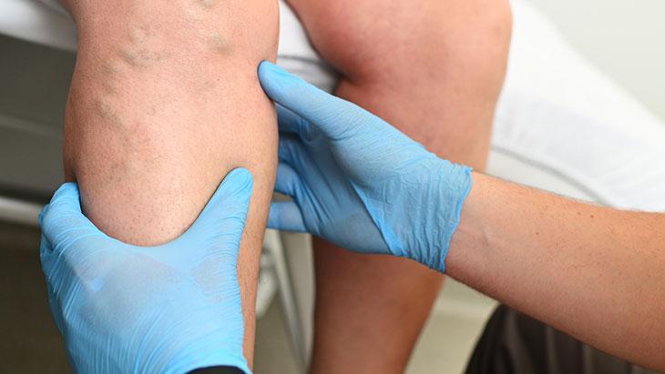 Fazla kilolar da varis riskini artırıyor