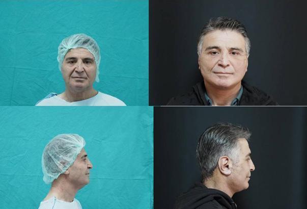 Devlet hastanesinde bir ilk Yüz germe operasyonuna girdi, 15 yıl gençleşerek çıktı