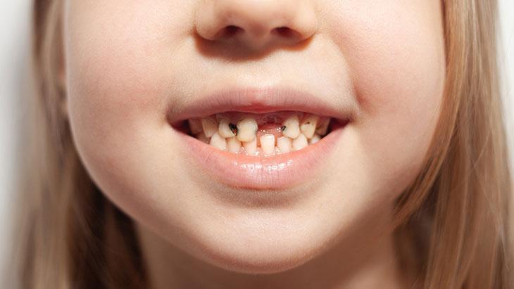 Ağız temizliğine, ilk diş görülmeden önce başlanmalı