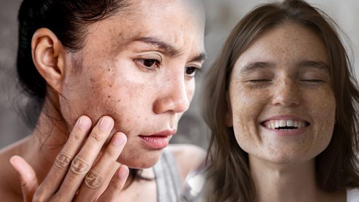 Cildi ışıl ışıl yapan doğal tarif Kararma sorununu kökten bitiriyor