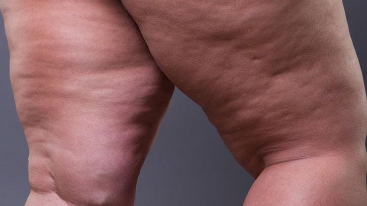 Kadınları etkiliyor, erkeklerde çok nadir rastlanıyor