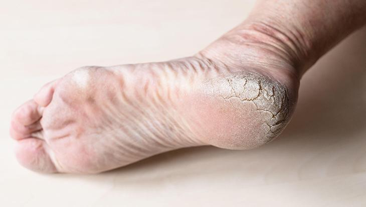 Ayaklardaki çatlaklara birebir 3 basit ürünle pürüzsüz oluyor Ayaklardaki çatlaklara birebir 3 basit ürünle pürüzsüz oluyor