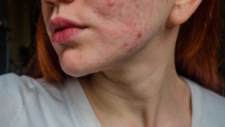 Egzama ile mücadelenin en doğal yolu Bütün dünya bu tarifi konuşuyor