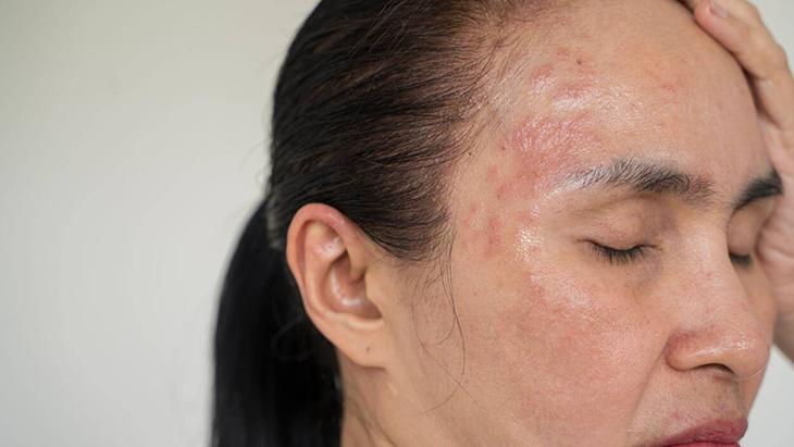 Egzama ile mücadelenin en doğal yolu Bütün dünya bu tarifi konuşuyor