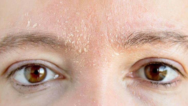 Egzama ile mücadelenin en doğal yolu Bütün dünya bu tarifi konuşuyor