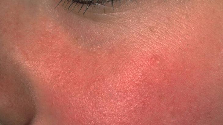 Egzama ile mücadelenin en doğal yolu Bütün dünya bu tarifi konuşuyor