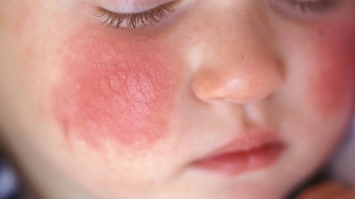 Egzama ile mücadelenin en doğal yolu Bütün dünya bu tarifi konuşuyor