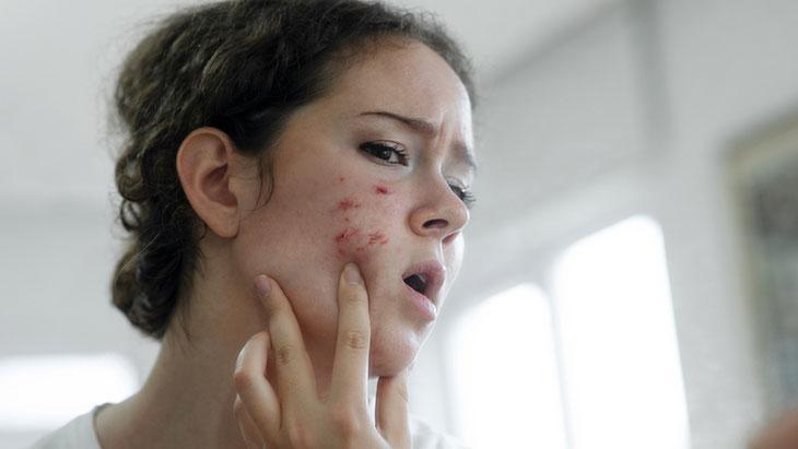 Siyah noktaları sıkmak