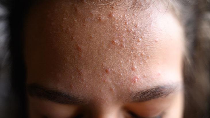 Vitamin ve mineral takviyelerini hatalı kullanmak