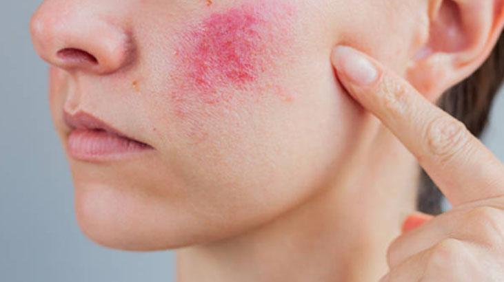 Öbek öbek çıkıyordu Cilt kızarıklığı için tek hamle: 2 hafta bu serumu sürdüm Öbek öbek çıkıyordu Cilt kızarıklığı için tek hamle: 2 hafta bu serumu sürdüm