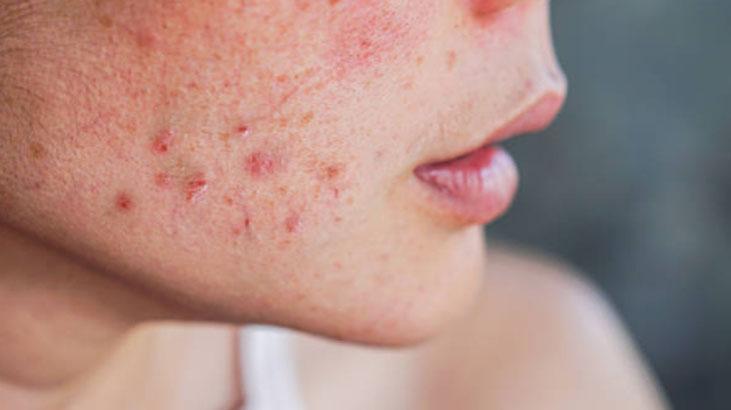 İrin akan sivilcelerinden kurtuldu Çözümü çok basit: İçeriği bu asitle dolu