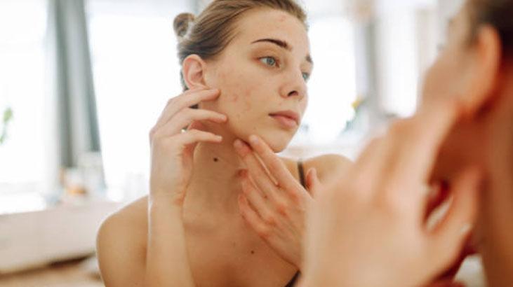 İrin akan sivilcelerinden kurtuldu Çözümü çok basit: İçeriği bu asitle dolu